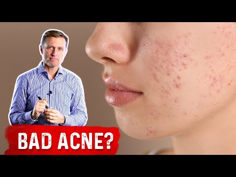 Acne: If Nothing is Working, Try This...