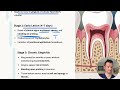 Perio 2 | RDH blueprint board exam Prep