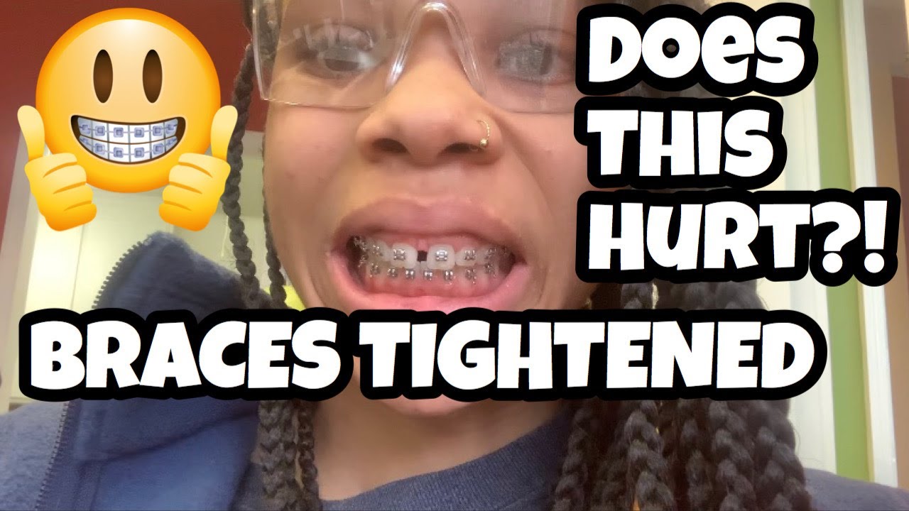 I GOT MY BRACES TIGHTENED ( 8 WEEK UPDATE ON BRACES ) YouTube