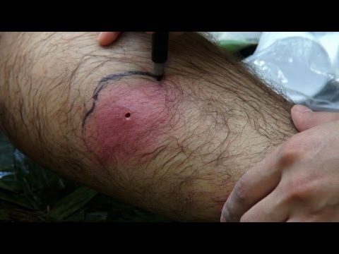 A Nasty Tick Bite On This Survivalist's Leg Is Badly Infected