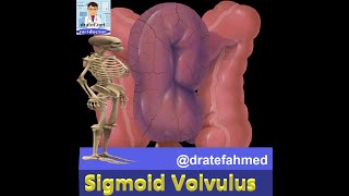 Sigmiod Volvulus / Causes / Pathology / Symptoms / Diagnosis  /Treatment /Medical Lecture /No1doctor