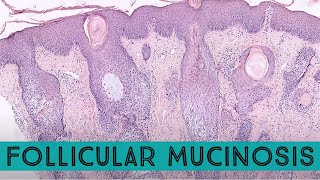 Follicular mucinosis & folliculotropic mycosis fungoides (cutaneous T-cell lymphoma)