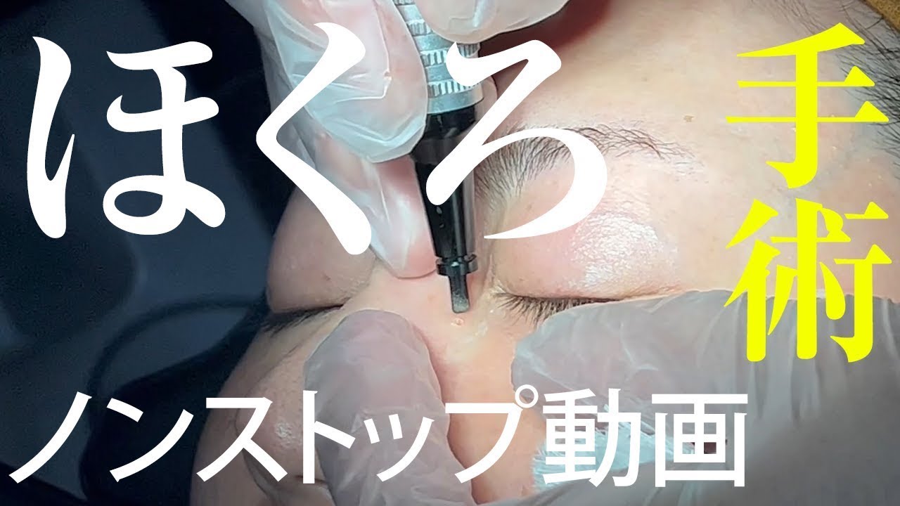 ほくろレーザー手術、全て見せます。【手術動画】 - YouTube