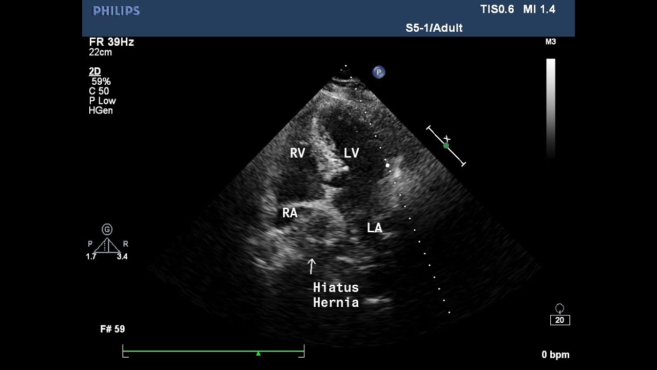 Echocardiographic Appearance Of Hiatus Hernia YouTube Echocardiographic Appearance Of Hiatus Hernia Youtube