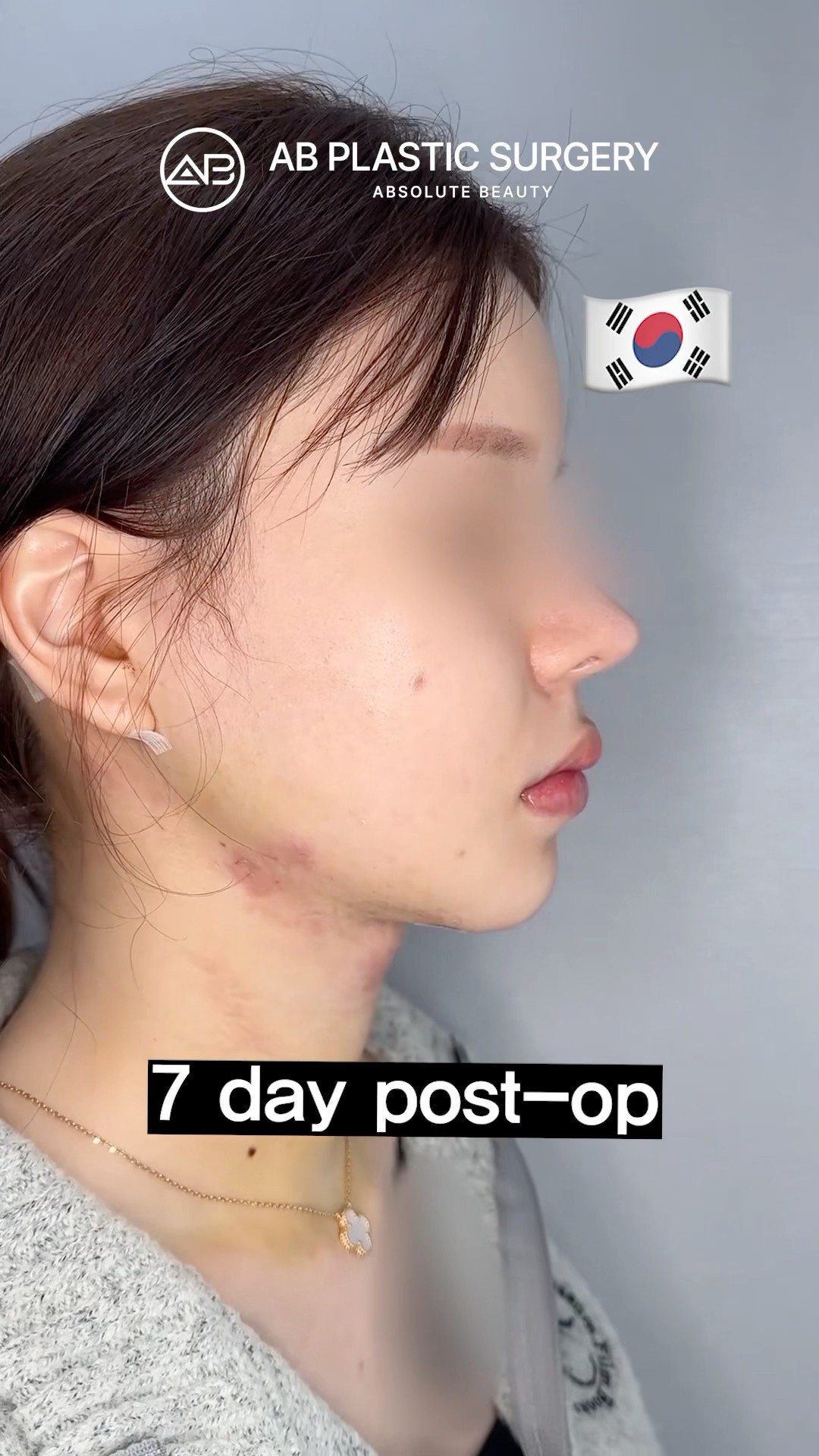 7-Day Jawline Makeover: Lipo, Threads, Tightening #koreanplasticsurgery
