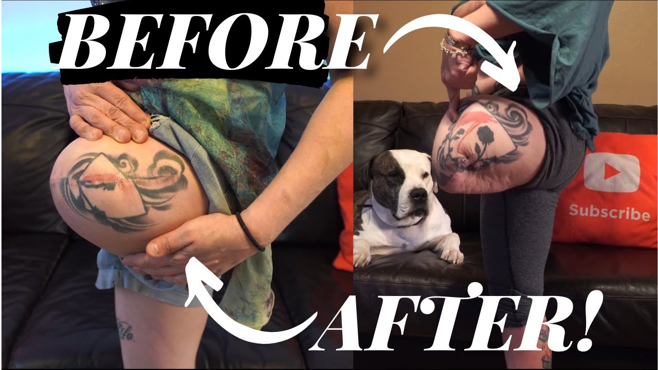 Comparing my Above Knee Residual Limb Before and After Revision: HUGE DIFFERENCE! (AK Amputee)