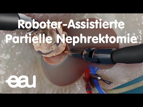 Roboter-Assistierte Partielle Nephrektomie