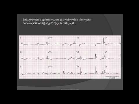 ეკგ. მარჯვენა პარკუჭის ჰიპერტროფია, ჰიპოთერმია, J კბილები (ოსბორნის კბილები)