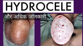 HYDROCELE - TREATMENT