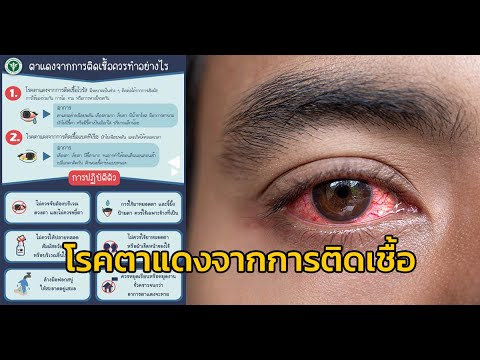 วีดีโอ: 3 วิธีในการป้องกันการติดเชื้อที่ตา