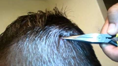 Choger removing staples from Kodine