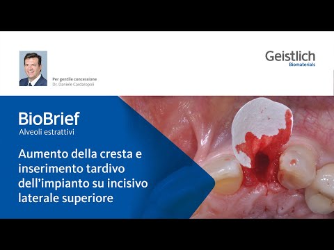 Video: Differenza Tra Mascellare Centrale E Incisivo Laterale