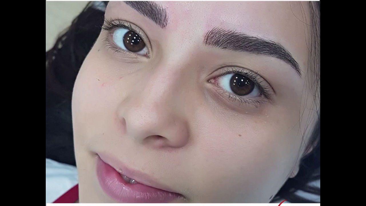 Despigmentação de Sobrancelhas a Laser para Remoção de Micropigmentação