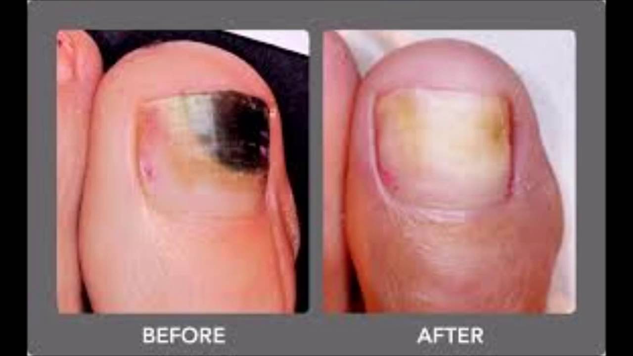 How Much Japanese Toenail Fungus Coder Toenail Fungus Q Clear Laser