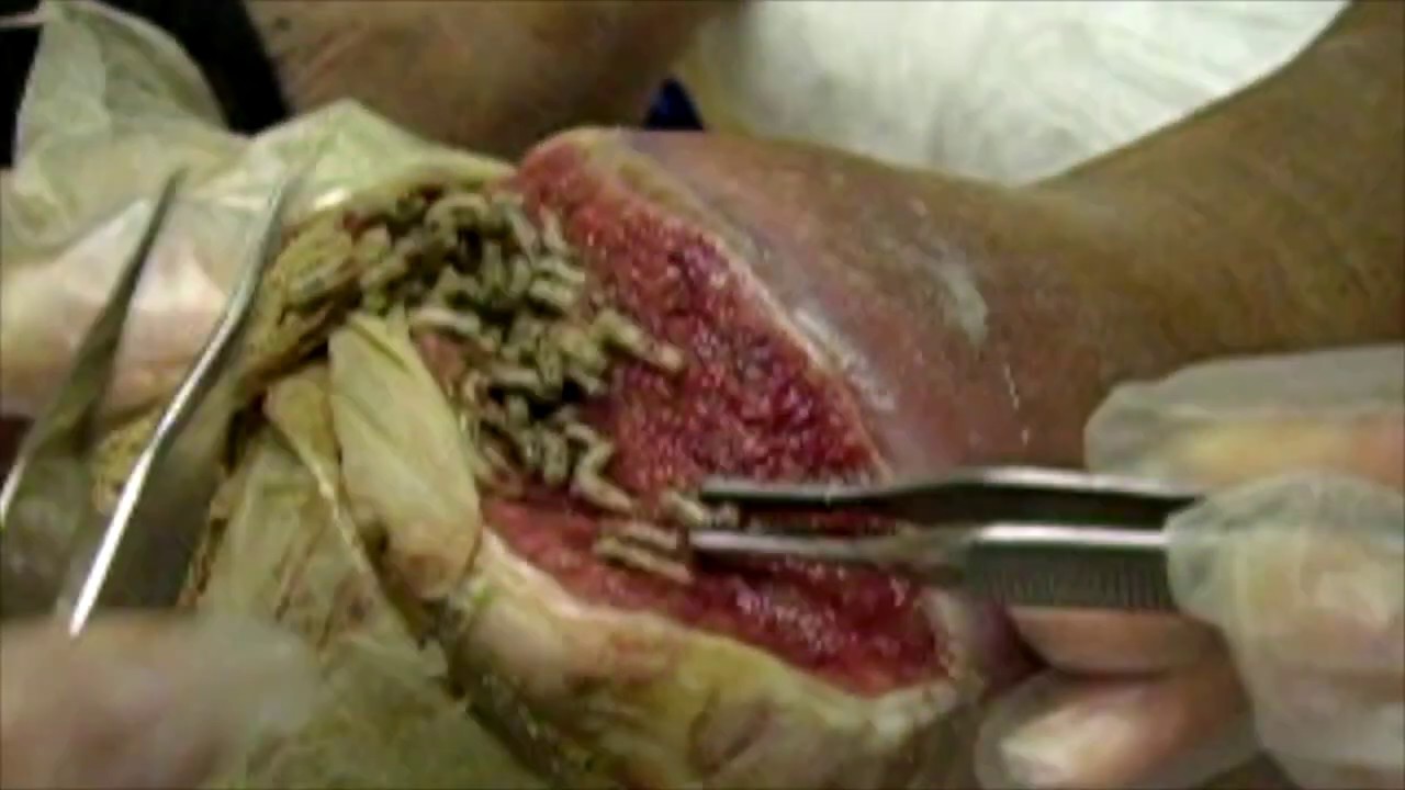 Medicinal maggots following first dressing change showing clean wound