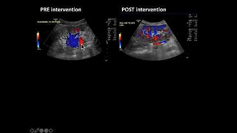 Case Review: Vascular & Interventional Radiology b...