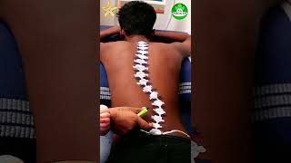 Spinal Cord Bend Problem Reason and Treatment #spinalcordinjury #spinalcordinjurysupport #discbulge