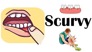 Scurvy (Vitamin C Deficiency) - Causes, Risk Factors, Signs & Symptoms, Diagnosis, And Treatment