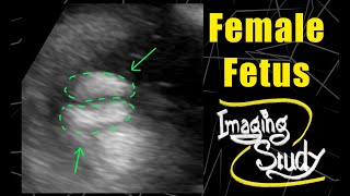 Female Fetus - It's a Girl || Ultrasound || Case 101