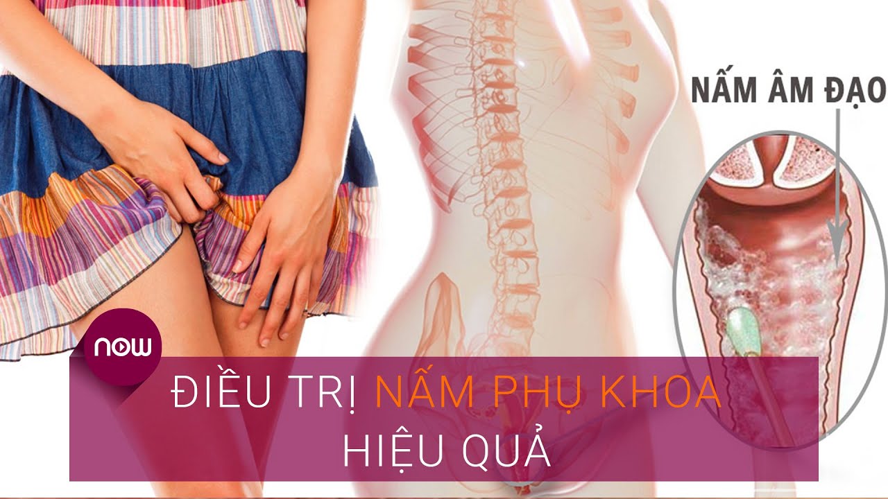 Nhận biết sớm, điều trị nấm phụ khoa hiệu quả | VTC Now