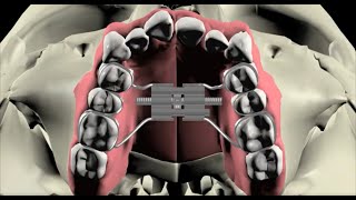 Are maxillary palatal expanders overused?