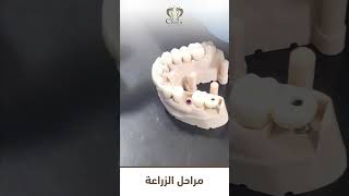 تعرّف على مراحل زراعة الأسنان