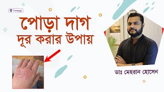 পোড়া দাগ দূর করার উপায় | Burn Marks Remove Treatment (4k) screenshot 3