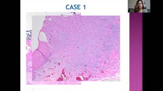 LG PathLab webinars:   Head &  Neck pathology : Case based discussions screenshot 5