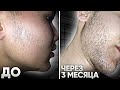 БУСТ ДЛЯ РОСТА БОРОДЫ в 17 ЛЕТ / Результаты ксиноксина за 3 месяца