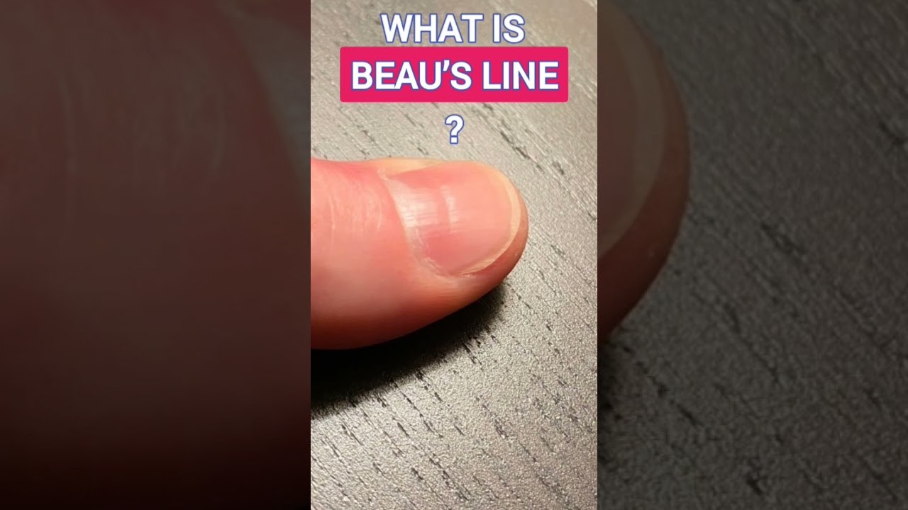 What is Beau’s Line on nail and its causes 