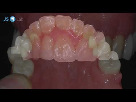 Video: Jak čistit zubní protézy: 13 kroků (s obrázky)
