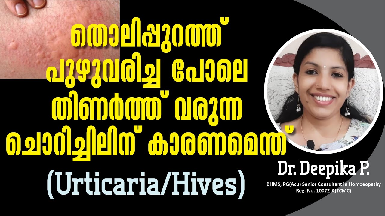 ശരീരത്തിൽ പുഴുവരിച്ച പോലെ ചൊറിഞ്ഞ് തിണർക്കുന്നതിന് കാരണമെന്ത്| Urticaria Treatment| Hives | Allergy