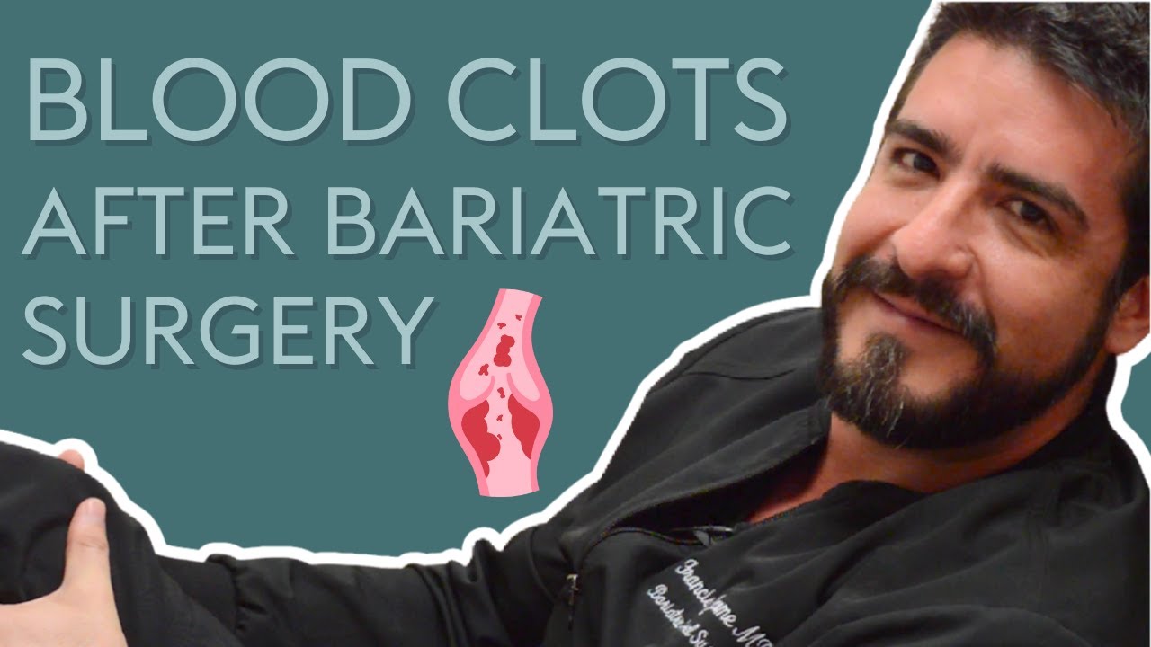Are Blood Clots a Risk after Bariatric Surgery? YouTube