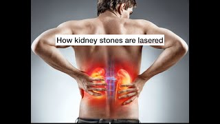 How are kidney stones lasered