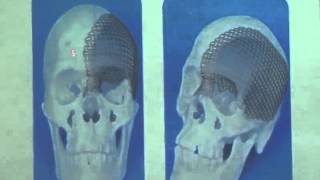 Half of man's skull replaced with 3D-printed prosthetic