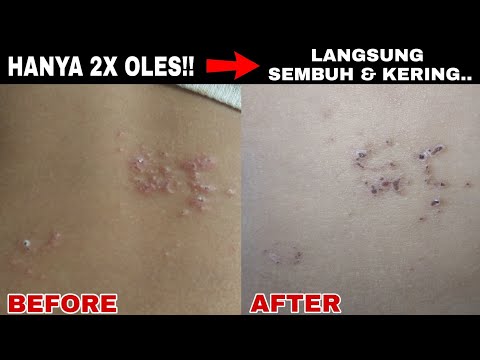 Hanya 2x oles! gatal-gatal,eks1m,c4car,dll langsung kering & sembuh..