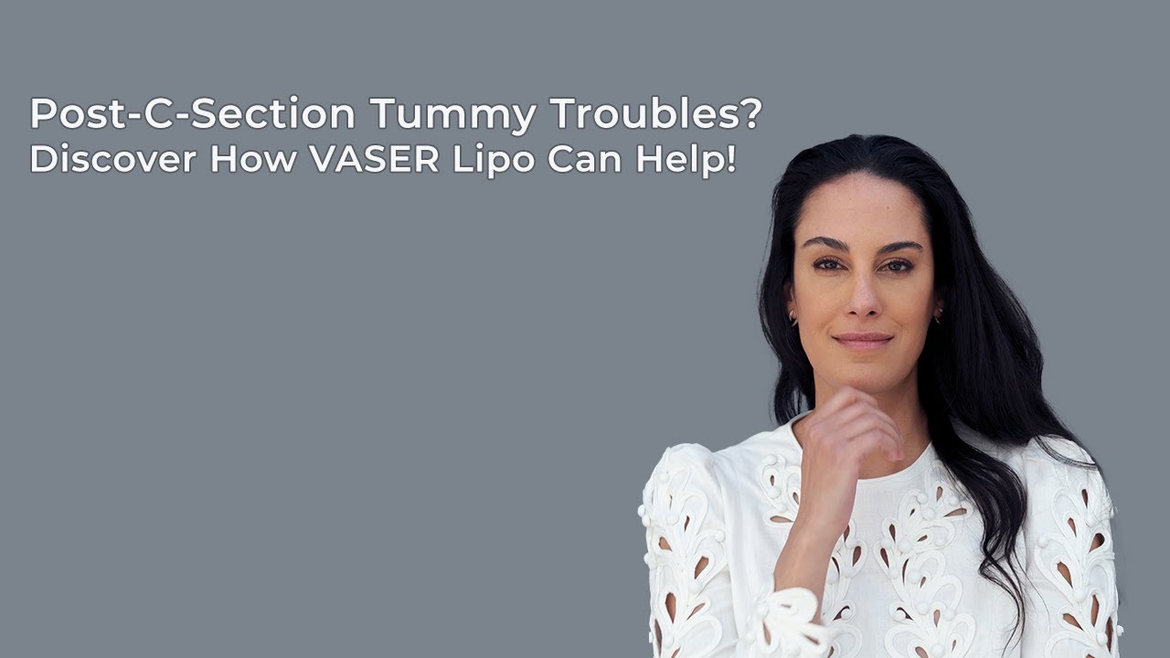 is l carnitine good for hair loss Post-C-Section Tummy Troubles? Discover How VASER Lipo Can Help!