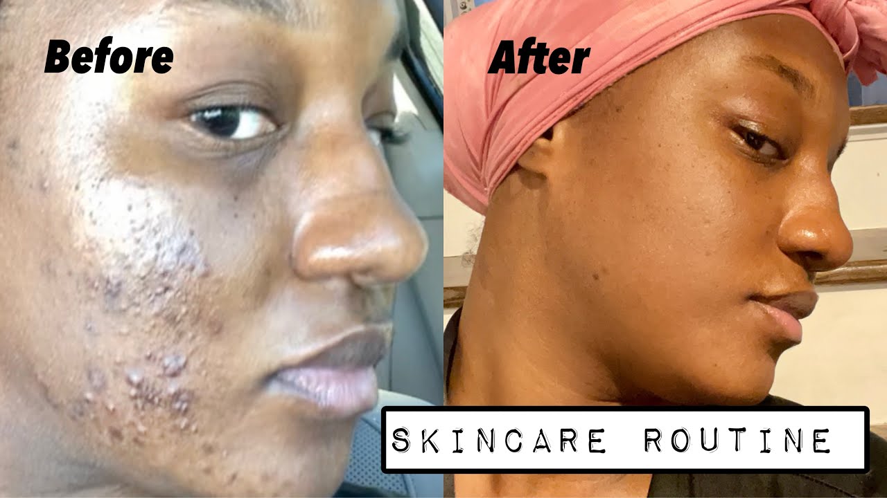 Skincare Routine | How I got rid of my acne and hyperpigmentation - YouTube
