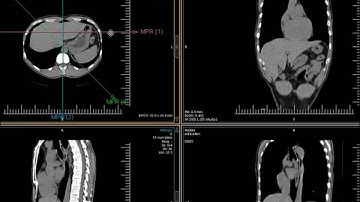 ClearCanvas Workstation: How To Use MPR