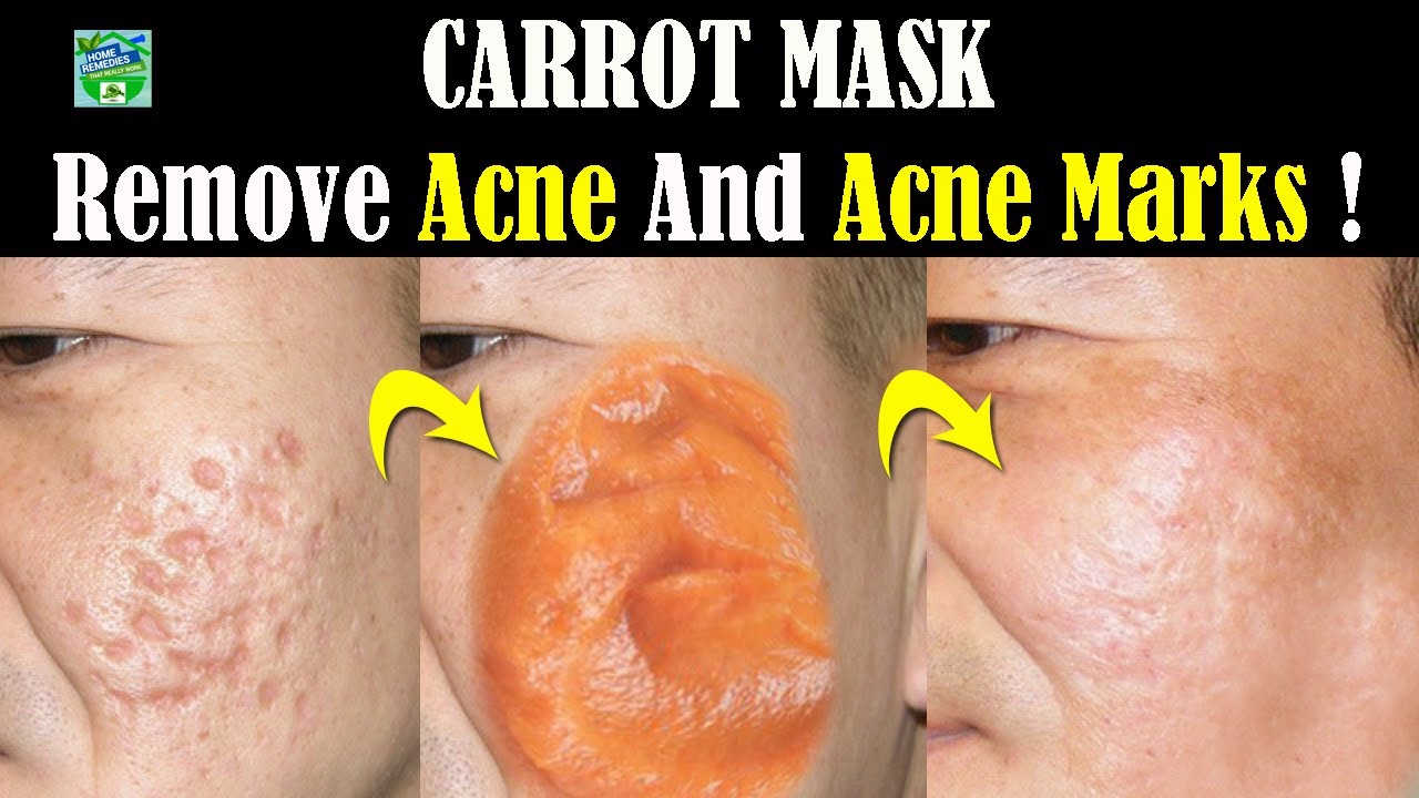 Carrot Mask To Remove Acne And Acne Marks ! YouTube