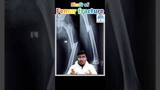 Femur Bone Fracture X-Ray Analysis 🔍 | मेडिकल स्टूडेंट्स के लिए आसान गाइड#bones #fracture #xray