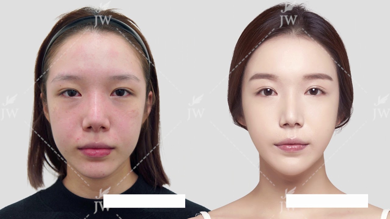 Nose Job in Korea - Na Eun's Real Story - JW Plastic Surgery Korea