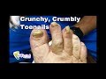 Crunchy, Crumbly Nails | Healthy Feet Podiatry of Tampa, Wesley Chapel & Brooksville Podiatrist