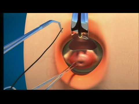 Vidéo: Septate Utérus: Comment Il Affecte La Grossesse, Détails De La Chirurgie