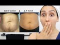 HOW TO TREAT STRETCH MARKS! IT WORKS!