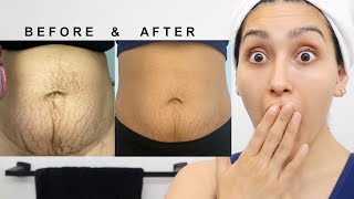 IMPROVE LOOSE SKIN, STRETCH MARKS & UNDER EYE CIRCLES
