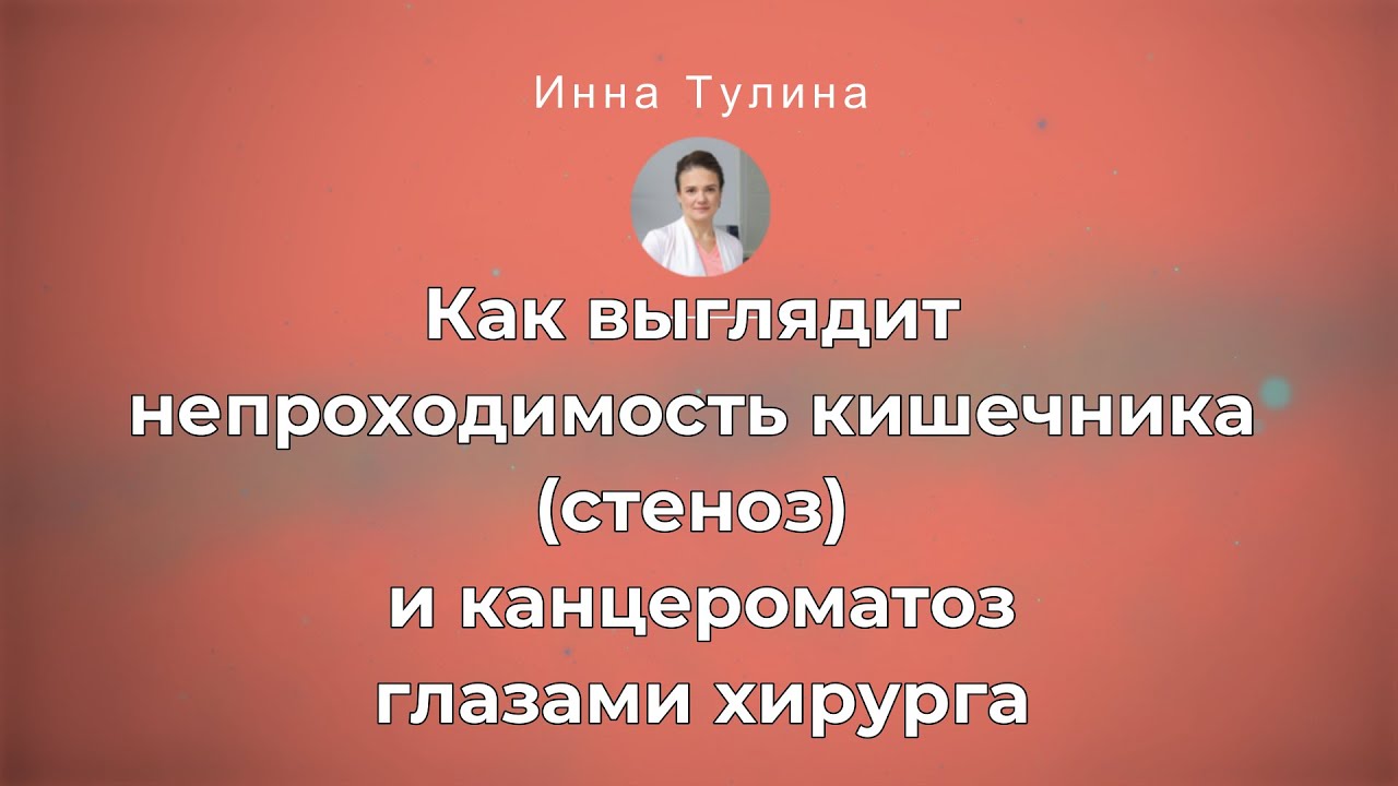 Как выглядит непроходимость кишечника (стеноз) и канцероматозглазами ...