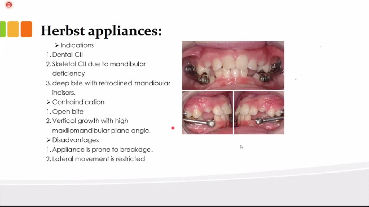Orthodontics L16 (myofunctional appliances 2) YouTube