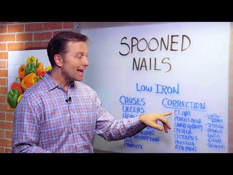 Spoon Nails: Causes & Treatments By Dr. Berg