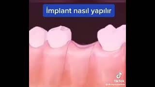 Diş Implant Animasyon 2023